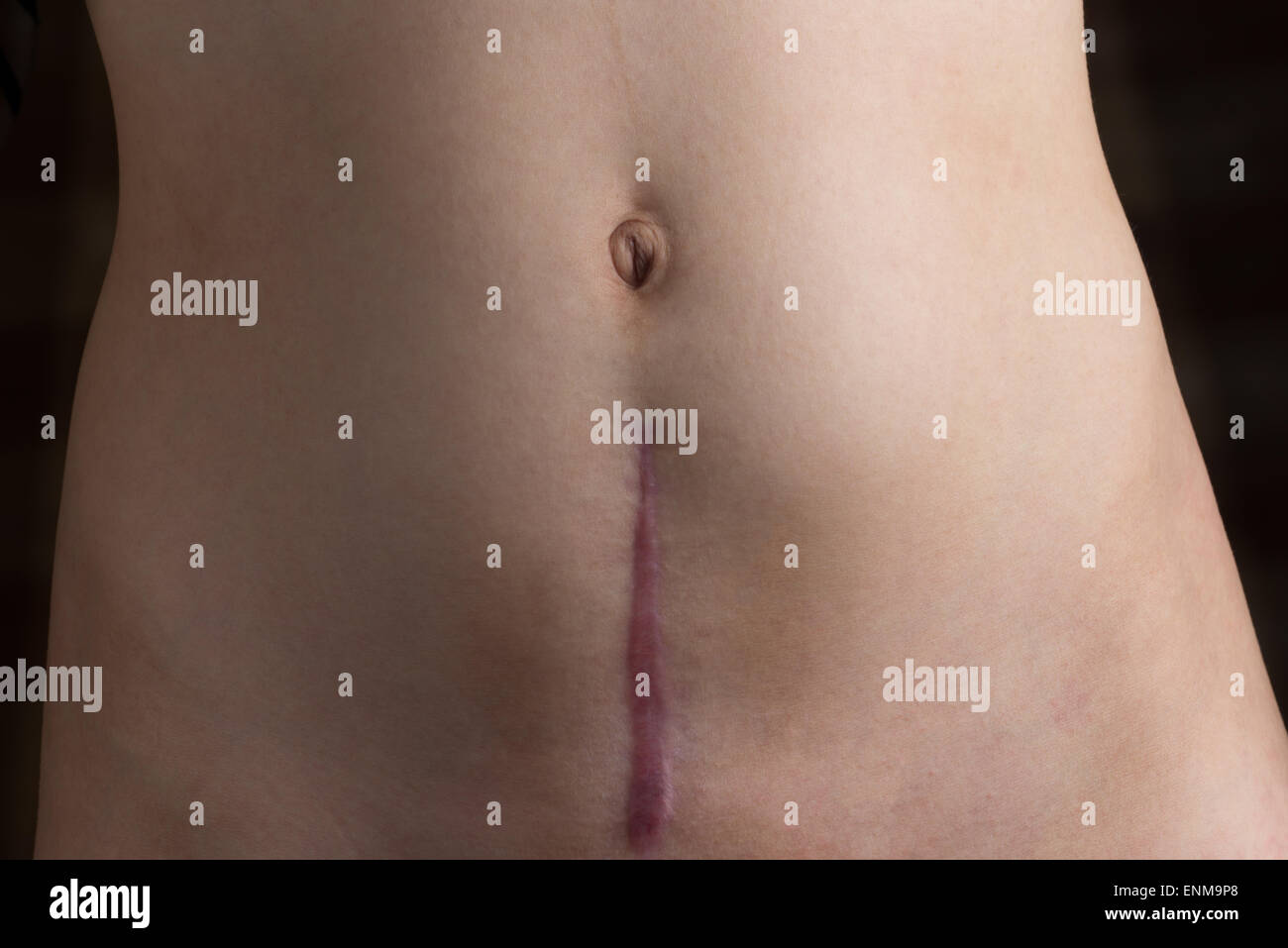 A recovering scar from a c-section operation. Stock Photo