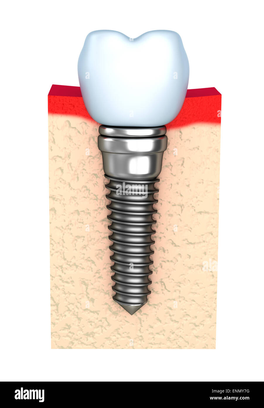 Dental implant in jaw bone Stock Photo Alamy