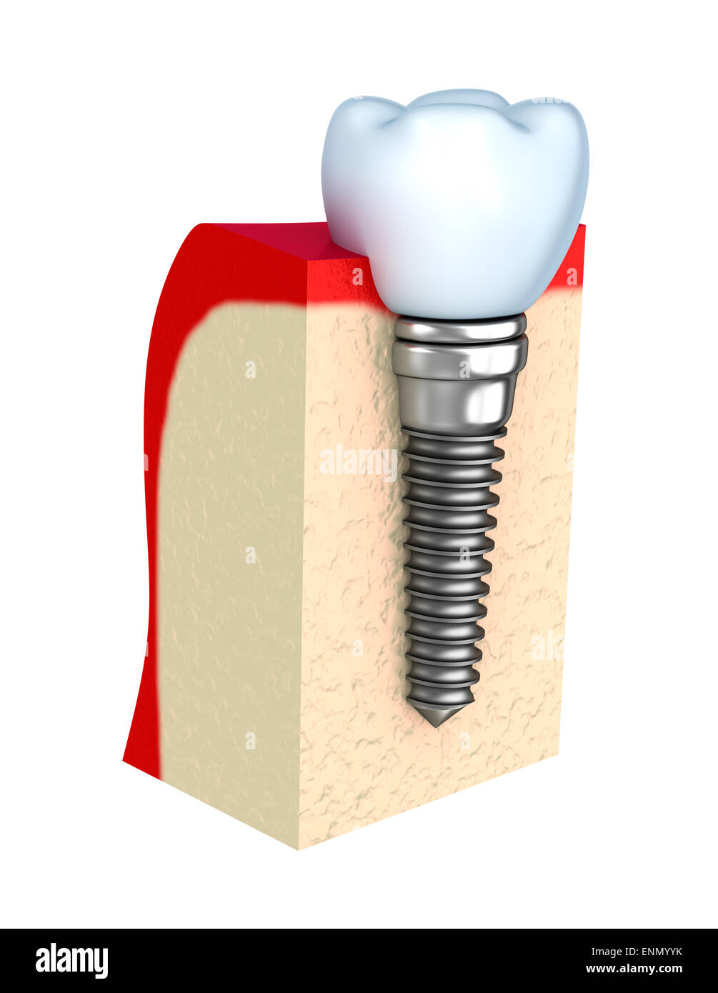 Dental implant in jaw bone Stock Photo Alamy