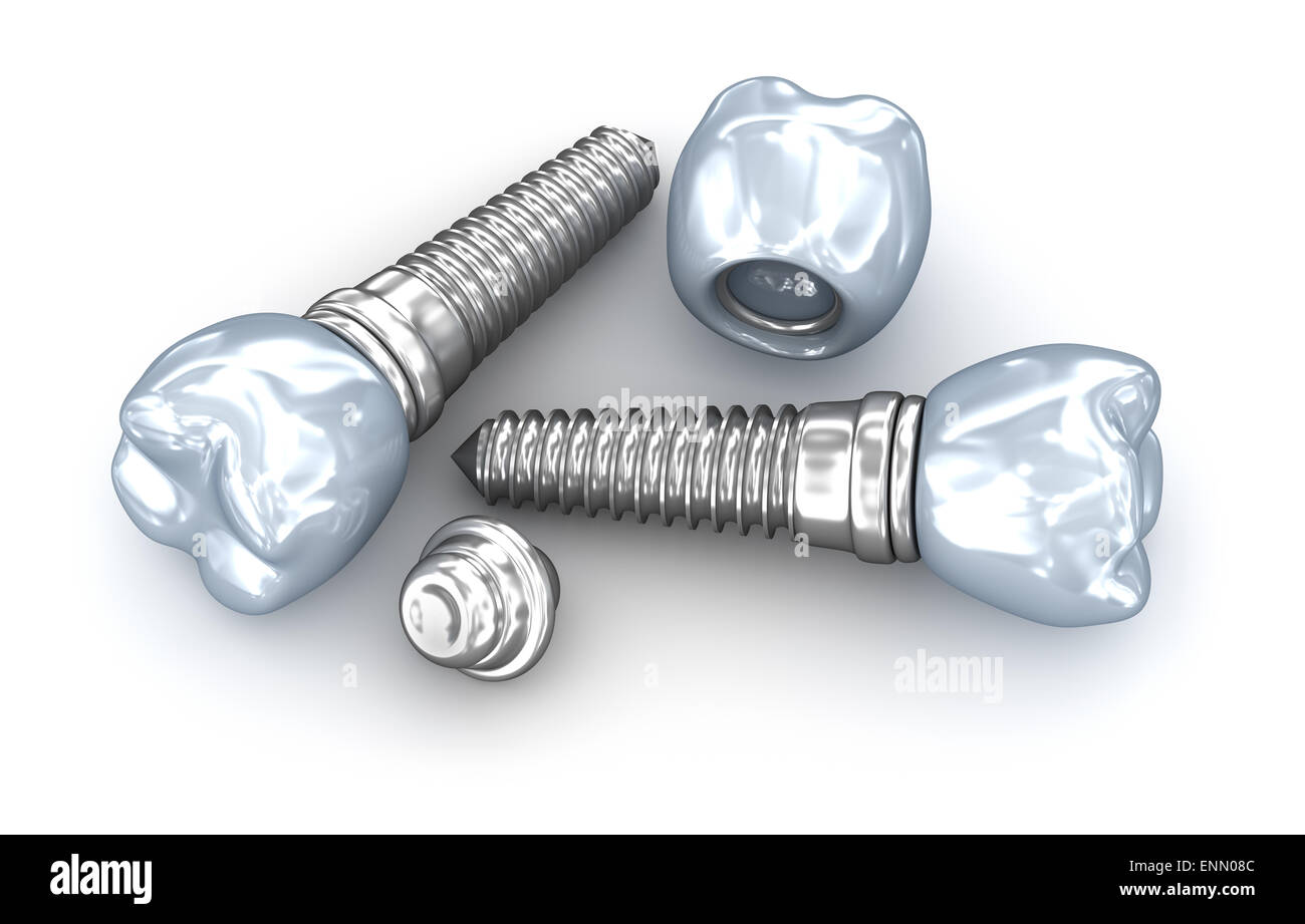 Dental implants, crown with pin isolated on white Stock Photo Alamy
