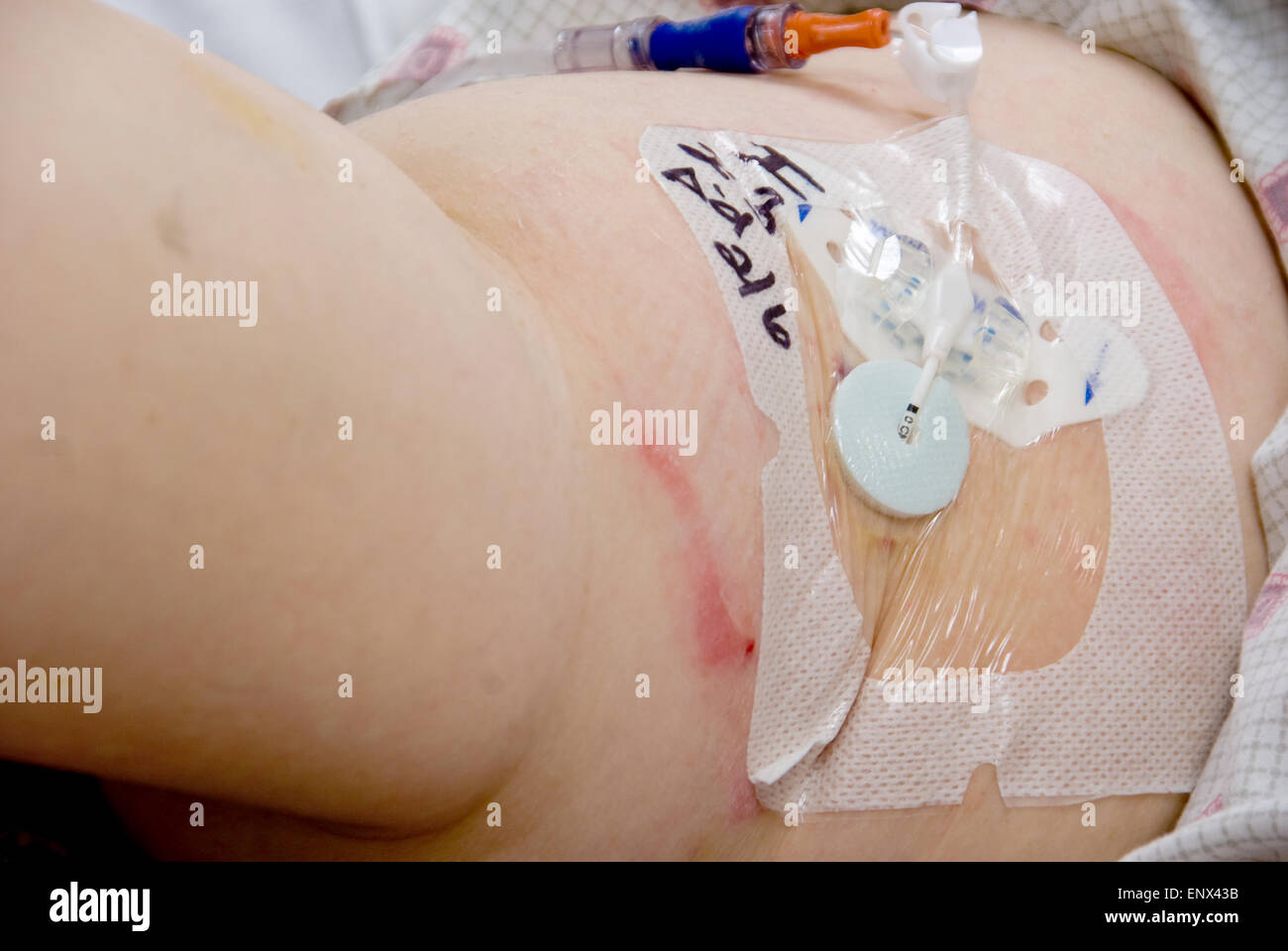 Picl Injection Picc Catheter High Resolution Stock Photography and Images - Alamy