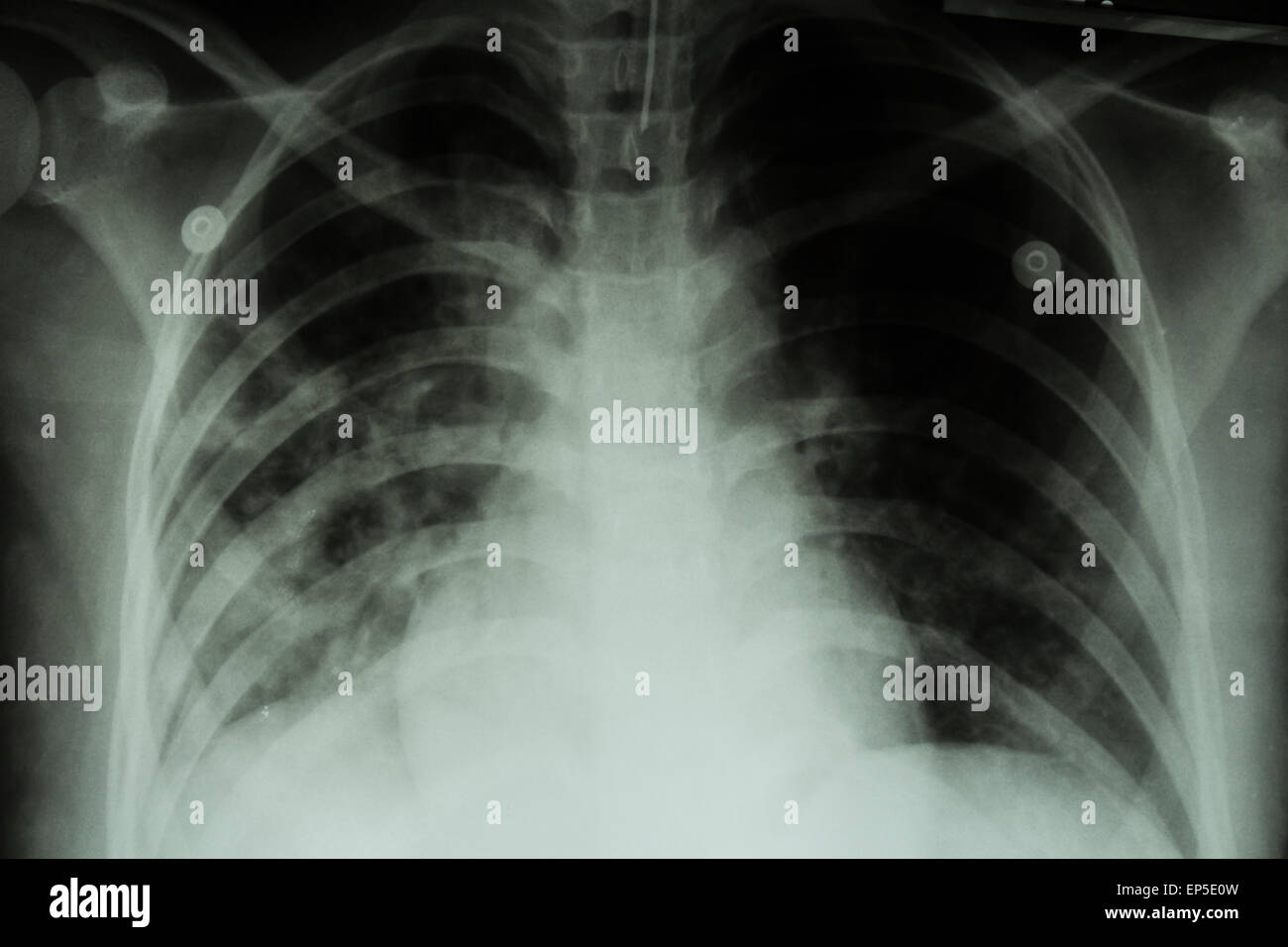 Pulmonary Tuberculosis ( TB )  :  Chest x-ray show alveolar infiltration at both lung due to mycobacterium tuberculosis infectio Stock Photo