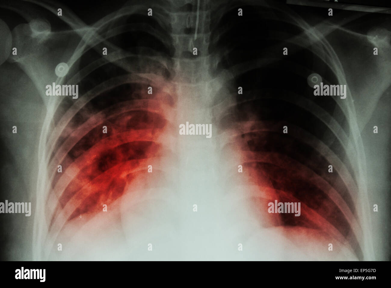 Pulmonary Tuberculosis ( TB )  :  Chest x-ray show alveolar infiltration at both lung due to mycobacterium tuberculosis infectio Stock Photo