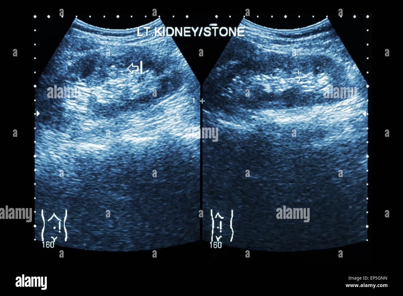 Ultrasound kidney stone hires stock photography and images Alamy