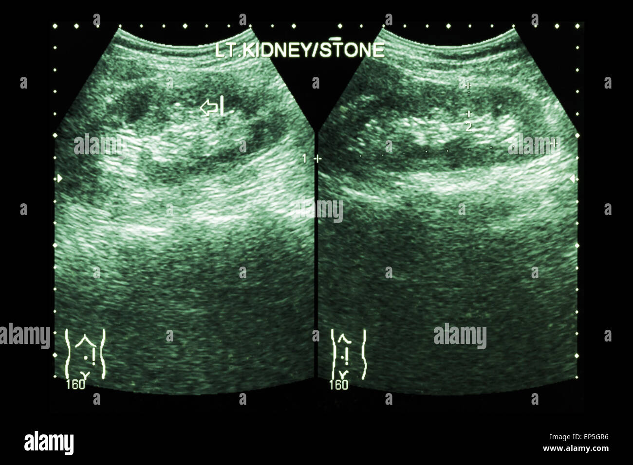 Ultrasonography of kidney : show left kidney stone ( 2 image for compare ) Stock Photo