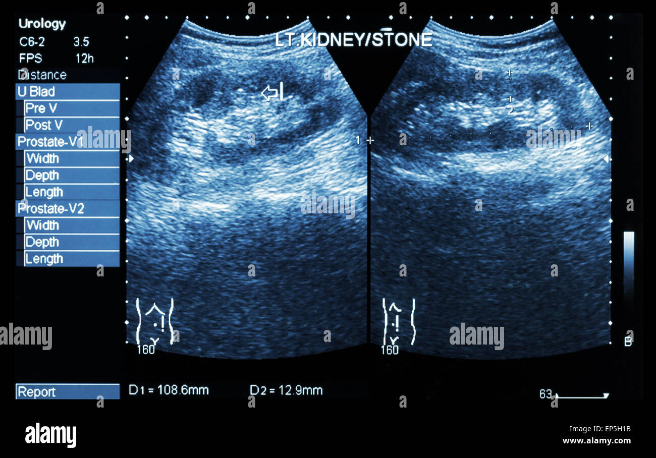 Ultrasonography of kidney : show left kidney stone ( 2 image for compare ) Stock Photo