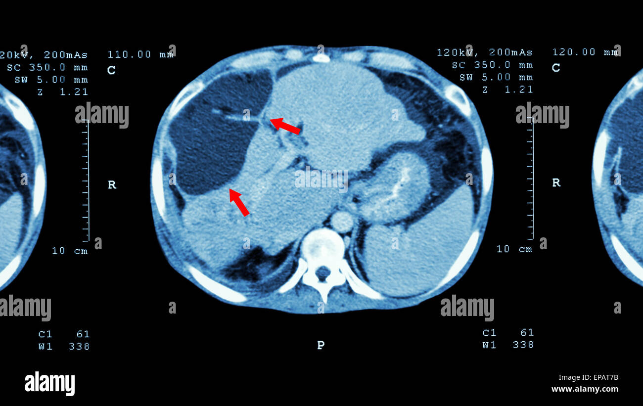 CT scan of upper abdomen : show abnormal mass at liver ( Liver cancer ) Stock Photo