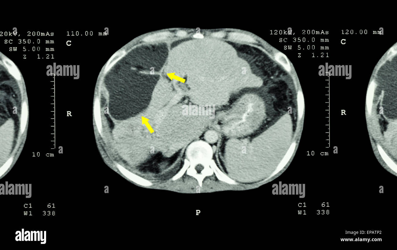 CT scan of upper abdomen : show abnormal mass at liver ( Liver cancer ) Stock Photo