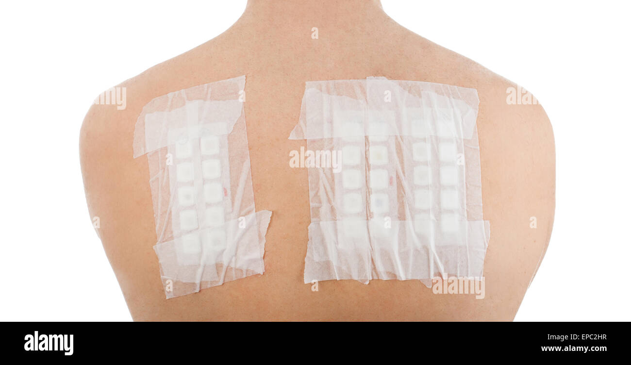 Skin Allergy Patch Test on Back of Male Patient On White Background Stock Photo
