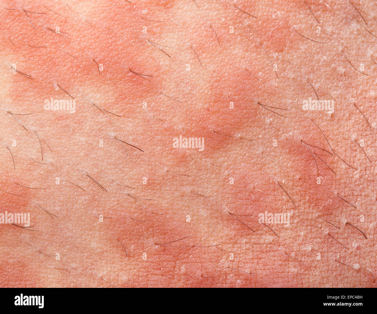 Eczema atopic dermatitis symptom skin texture Stock Photo