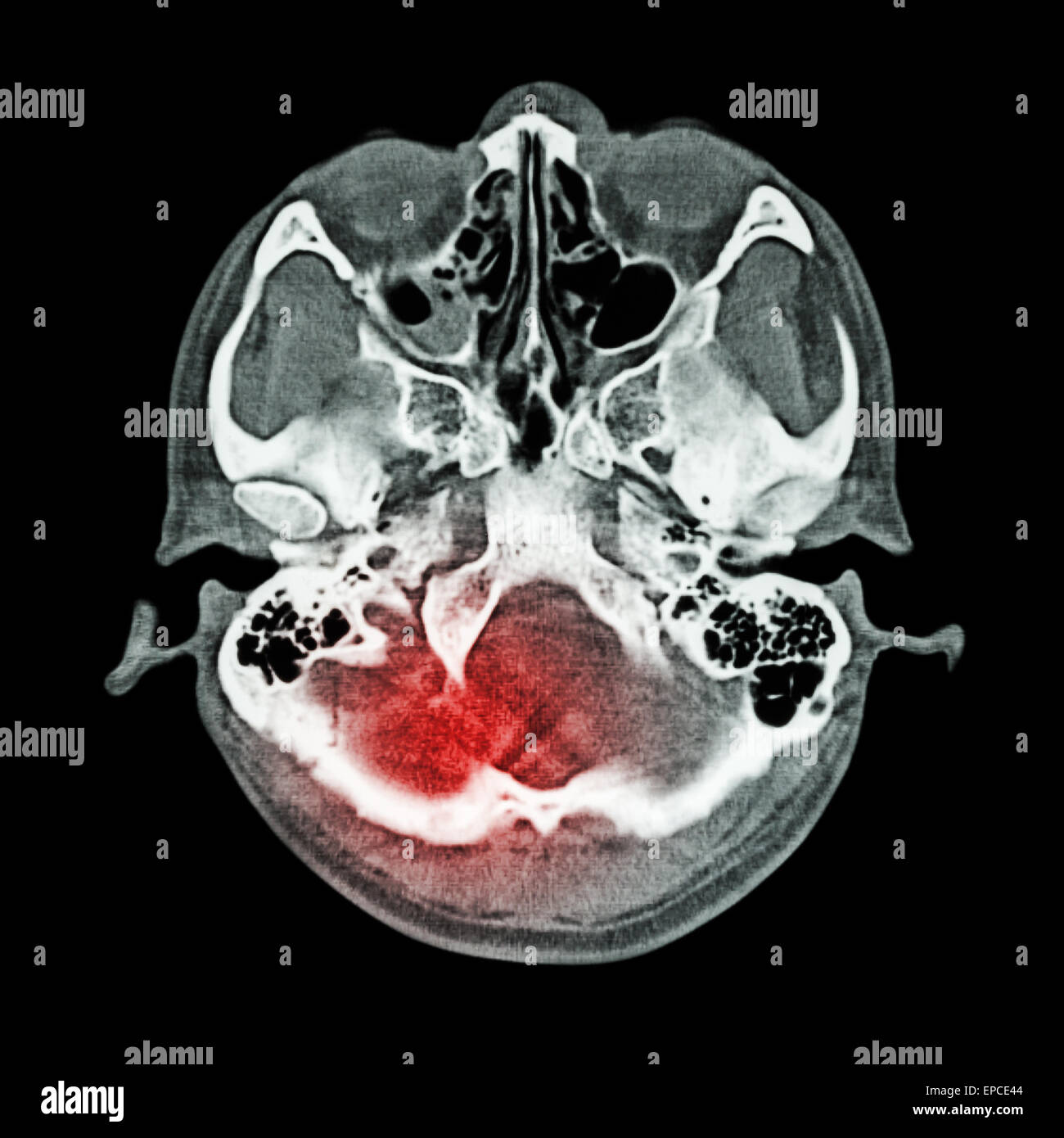 Brain injury, Stroke : ( CT scan of brain and base of skull ) ( Bone window ) Stock Photo