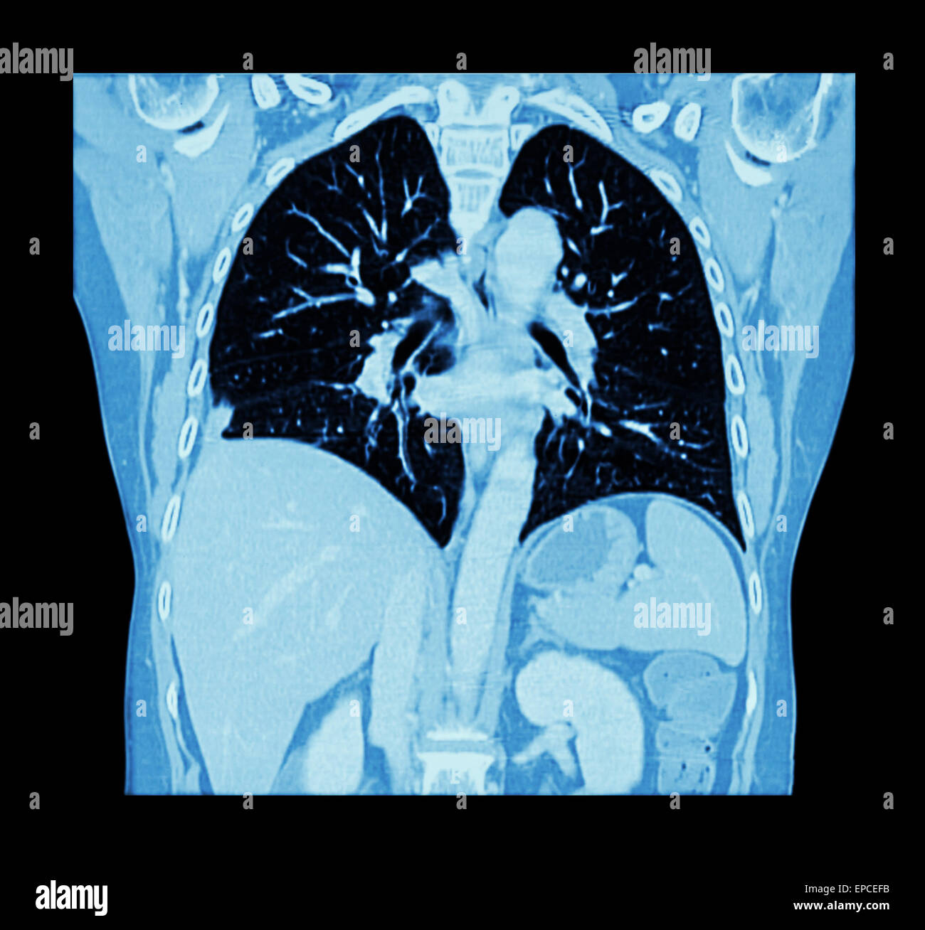 Lung cancer ( CT scan of chest and abdomen show right lung cancer