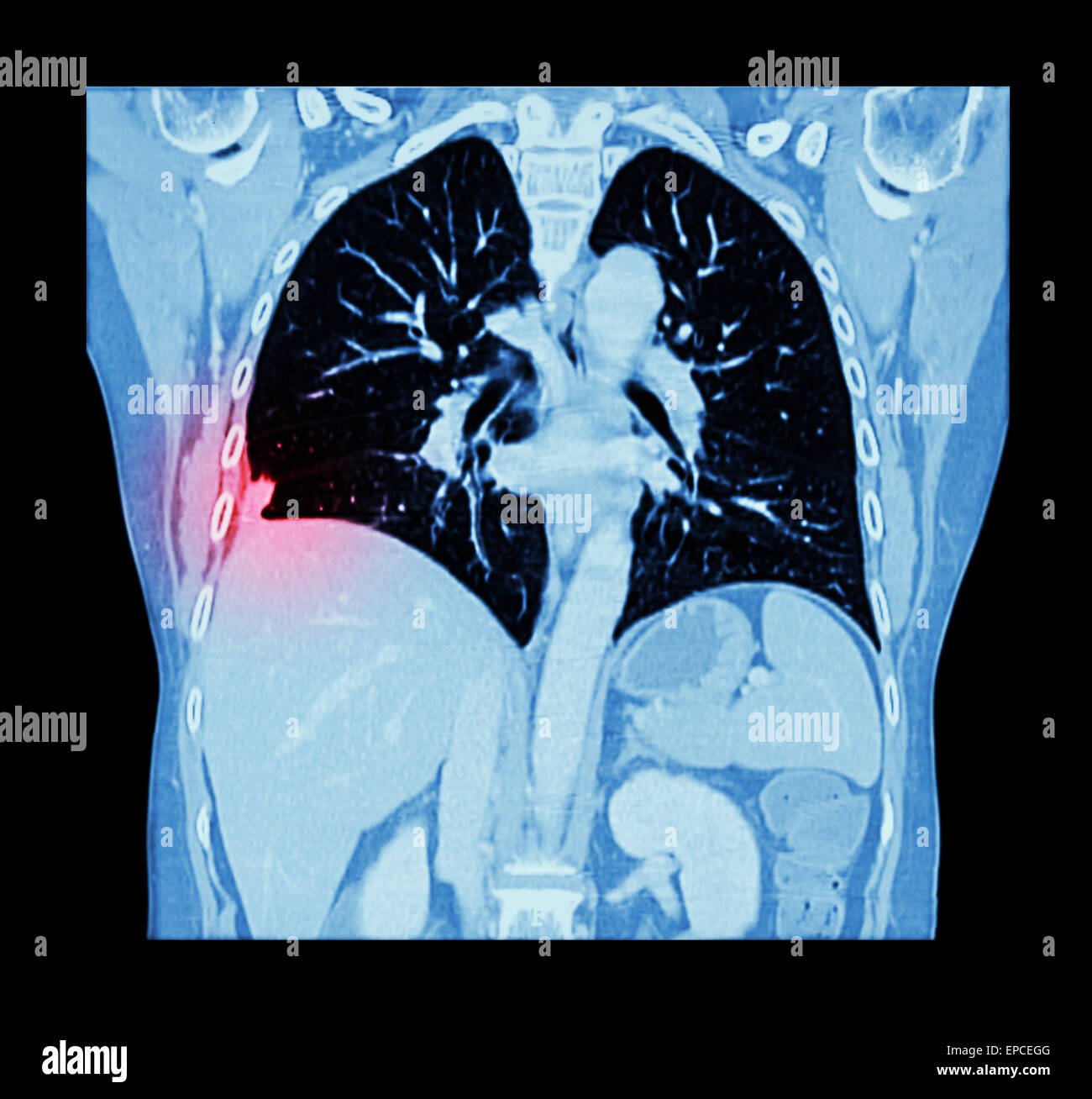 Lung cancer ( CT scan of chest and abdomen show right lung cancer