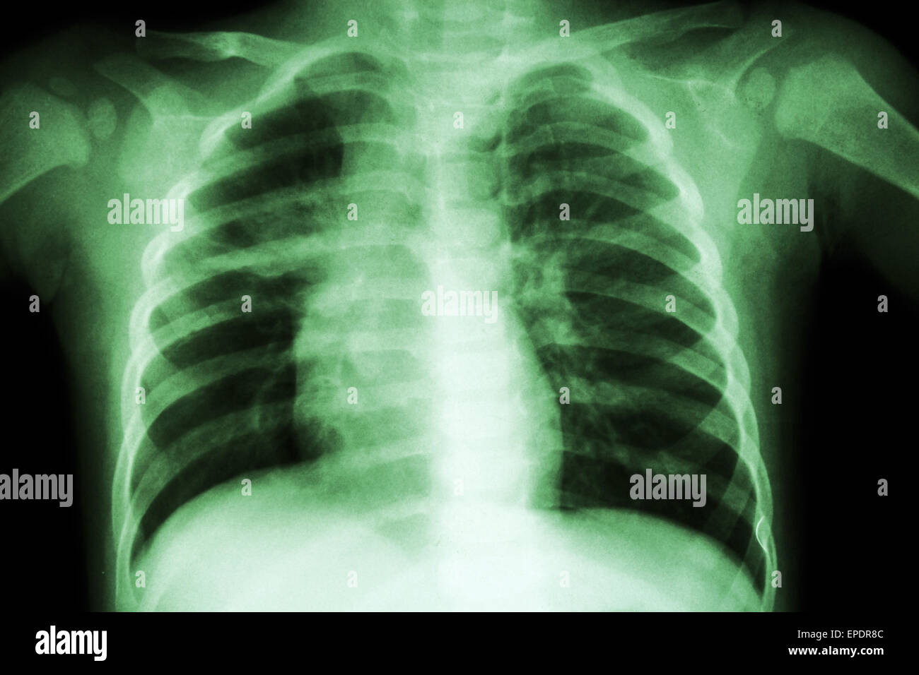 Pulmonary Tuberculosis ( Chest Xray of child show patchy