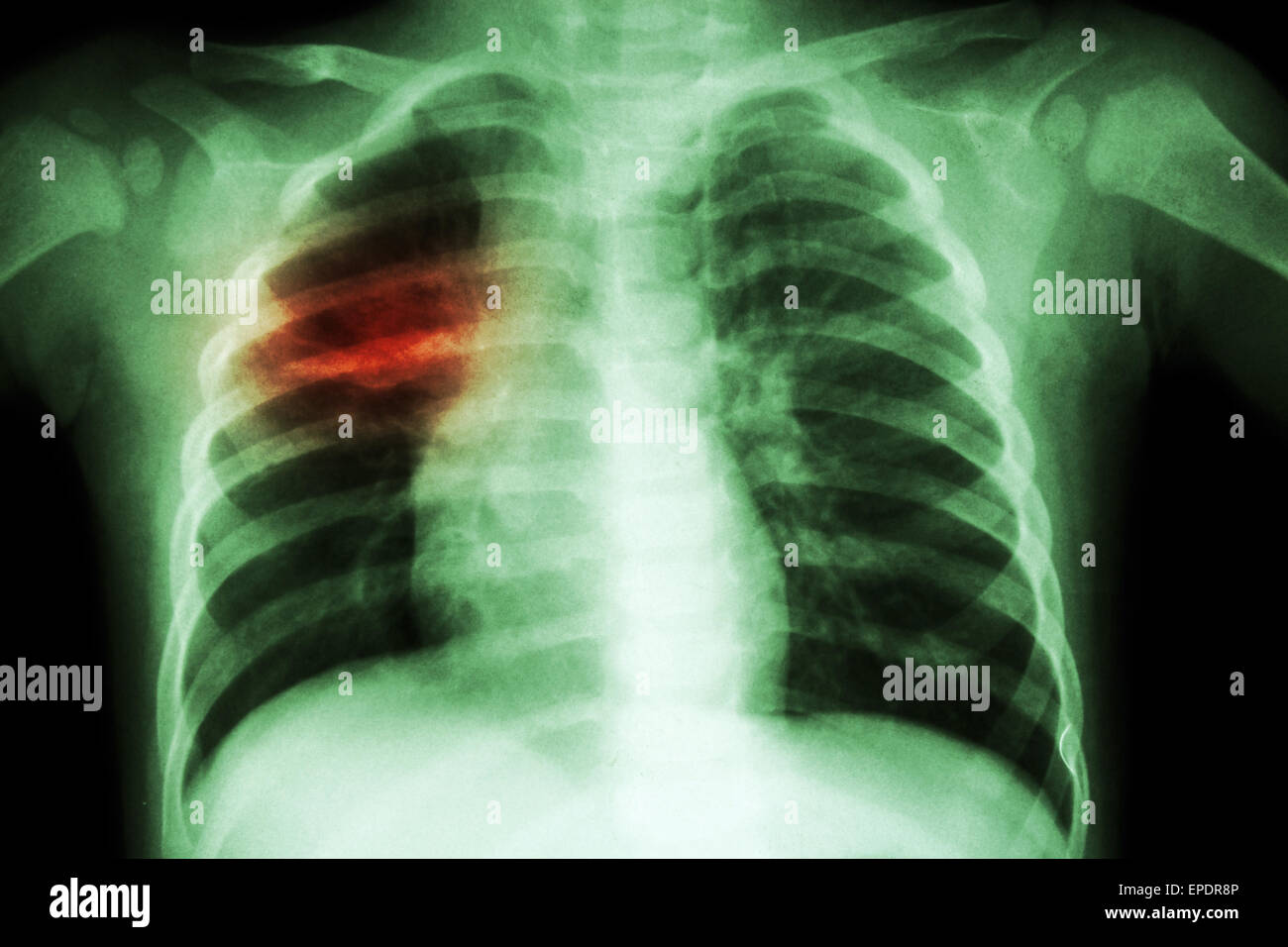 Pulmonary Tuberculosis ( Chest Xray of child show patchy