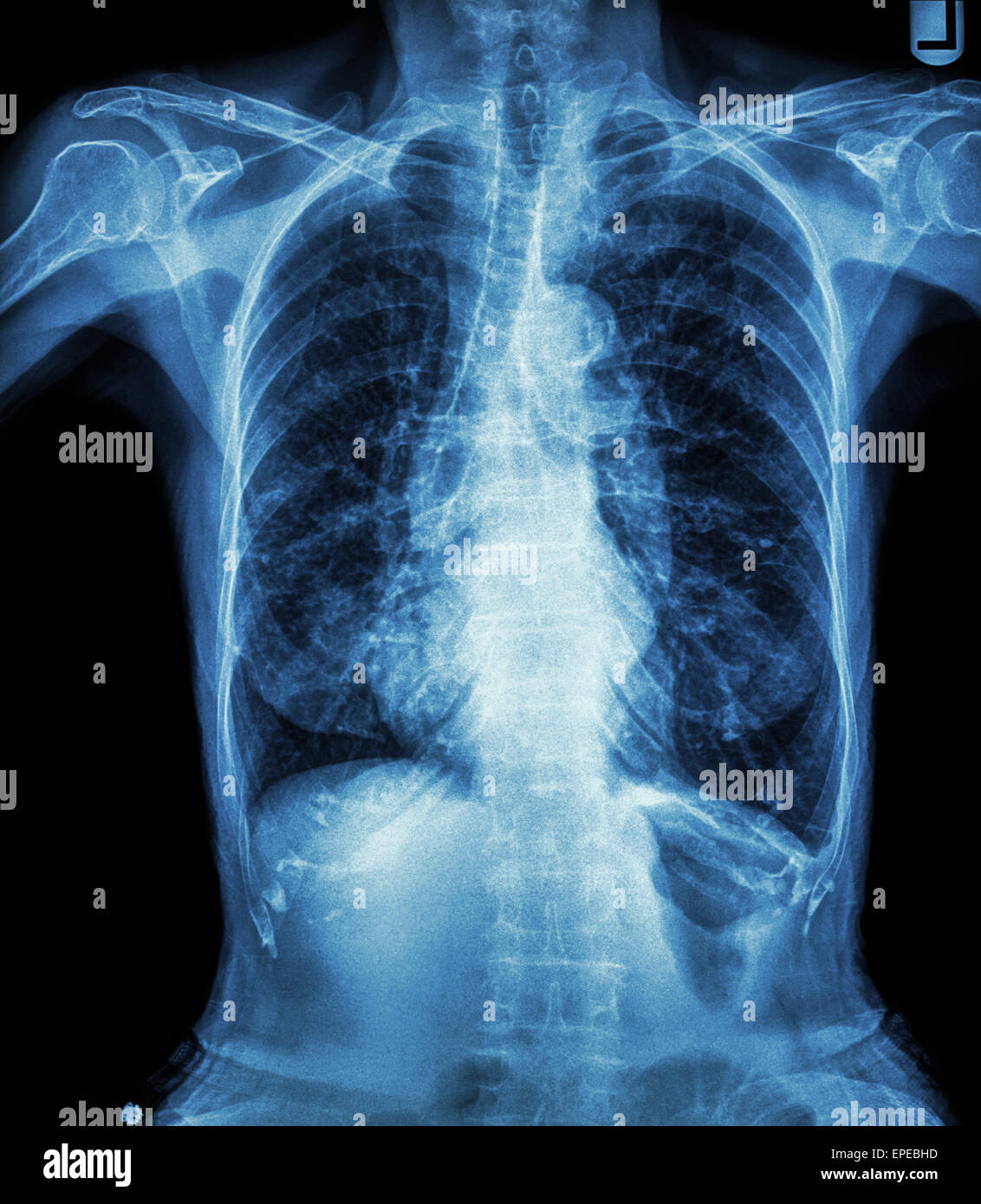 Chest Xray of old patient ( calcification at rib , trachea , bronchus