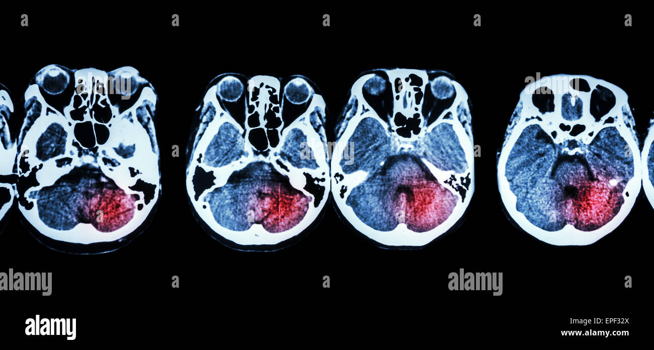 Stroke  ( CT scan of brain and base of skull and Stroke ) Stock Photo
