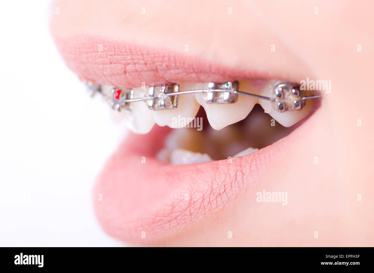 Mouth with brackets braces in medical concept Stock Photo Alamy
