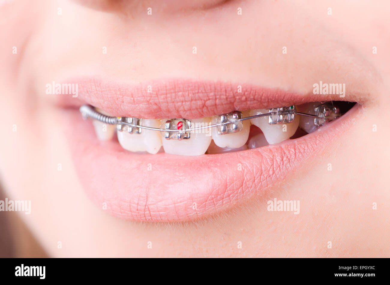 Premium Photo  Braces with blue and yellow rubber bands closeup