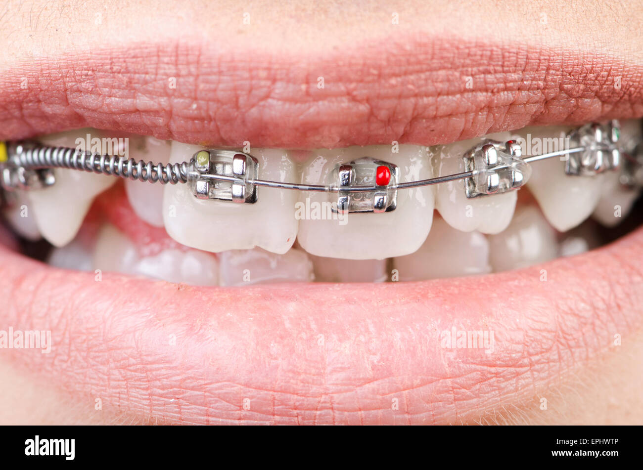 Mouth with brackets braces in medical concept Stock Photo Alamy