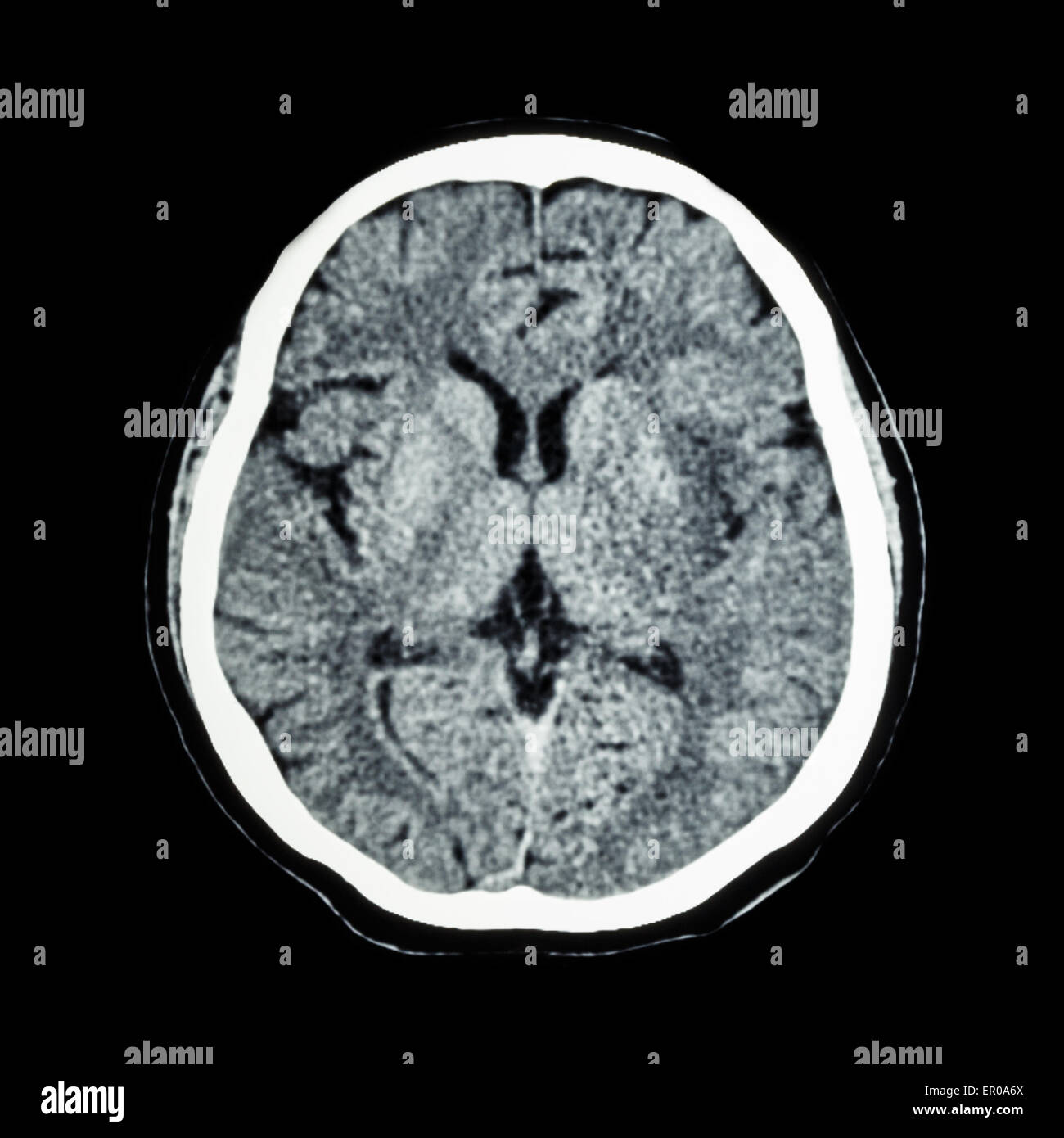 CT scan of brain : show normal human 's brain ( CAT scan ) Stock Photo