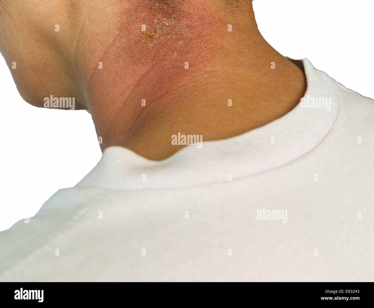itchy rash on asian woman neck isolated on white background Stock Photo