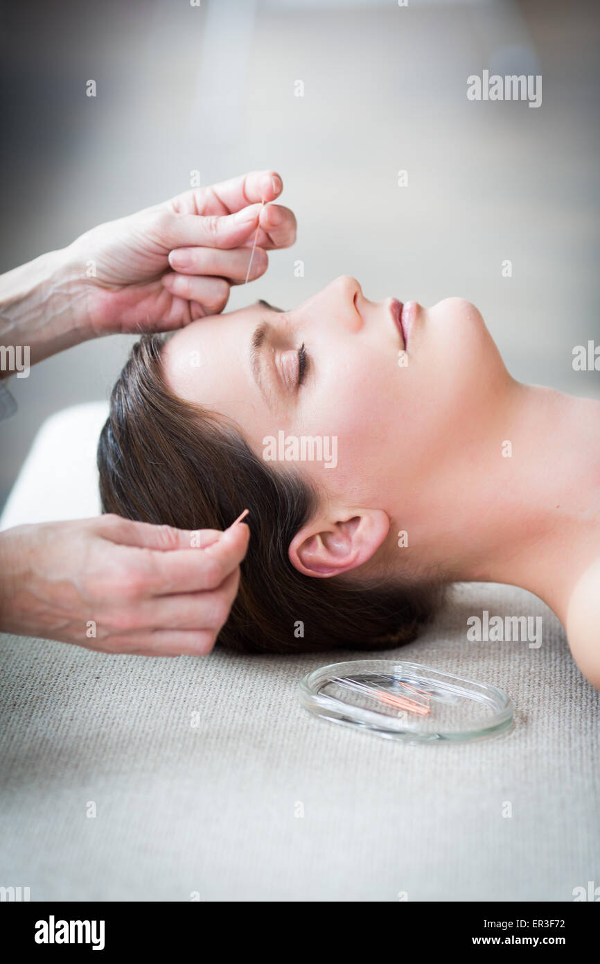 Woman receiving acupunture. Stock Photo