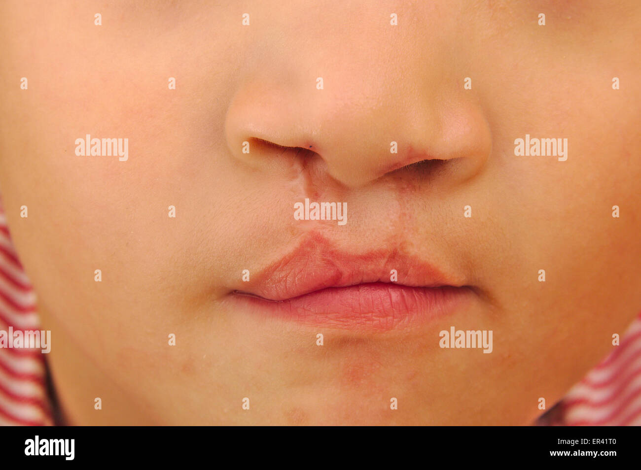 Boy showing a bilateral cleft lip repaired Stock Photo