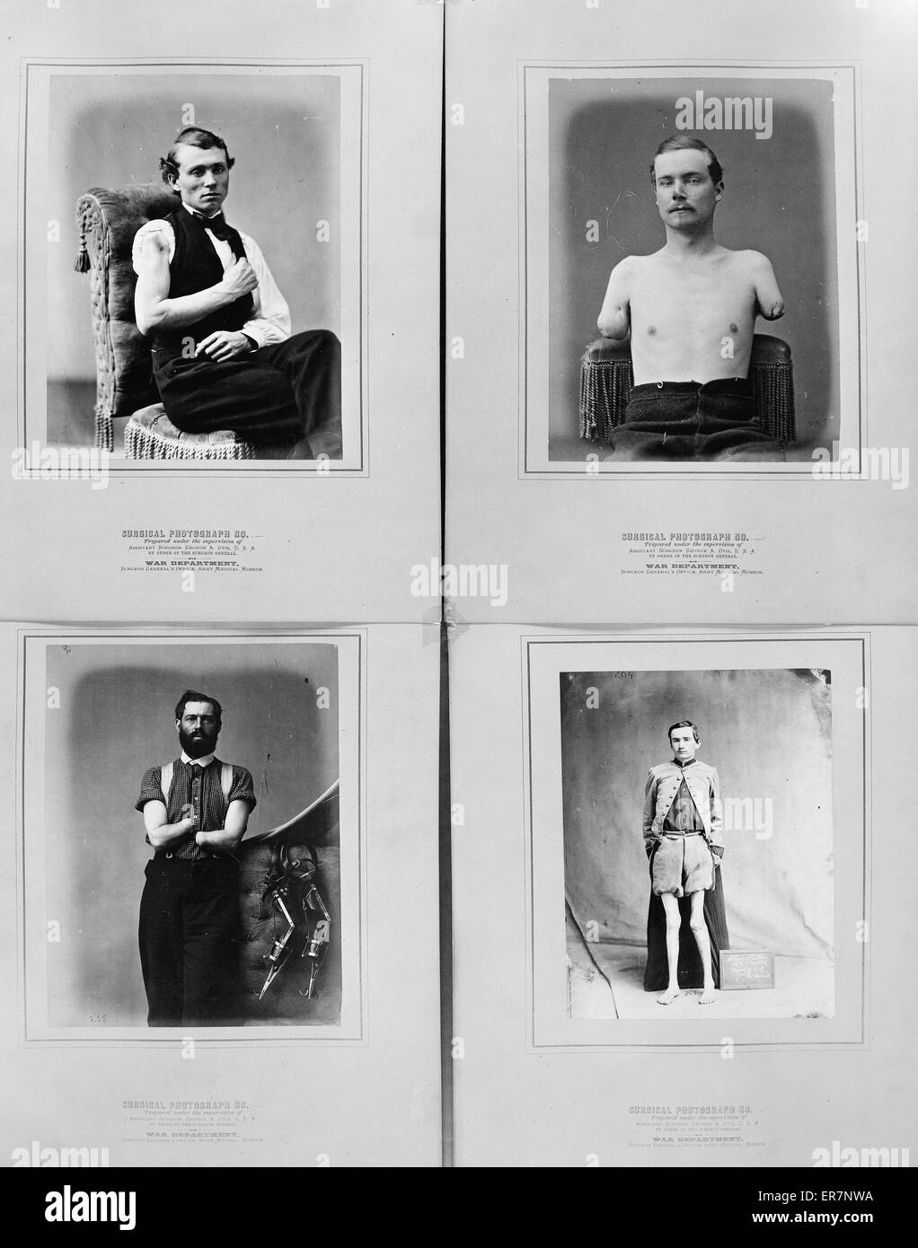 Surgical photograph  prepared under the supervision of  War Department, Surgeon General's Office, Army Medical Museum. Photographs show men displaying the wounds received during the Civil War. Upper left: John Brink, Private, Company K, 11th Pennsylvania Stock Photo