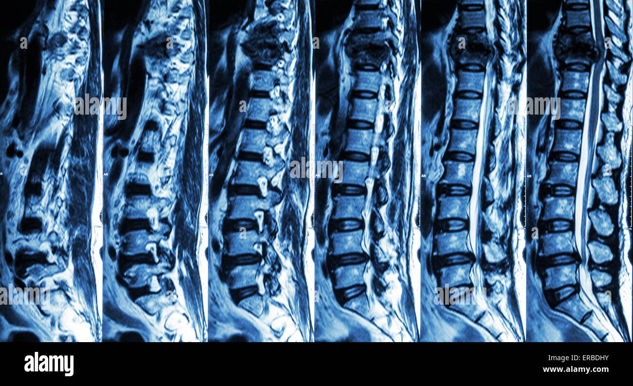 MRI of Lumbar & Thoracic spine : show fracture of thoracic spine and compress spinal cord ( Myelopathy ) Stock Photo