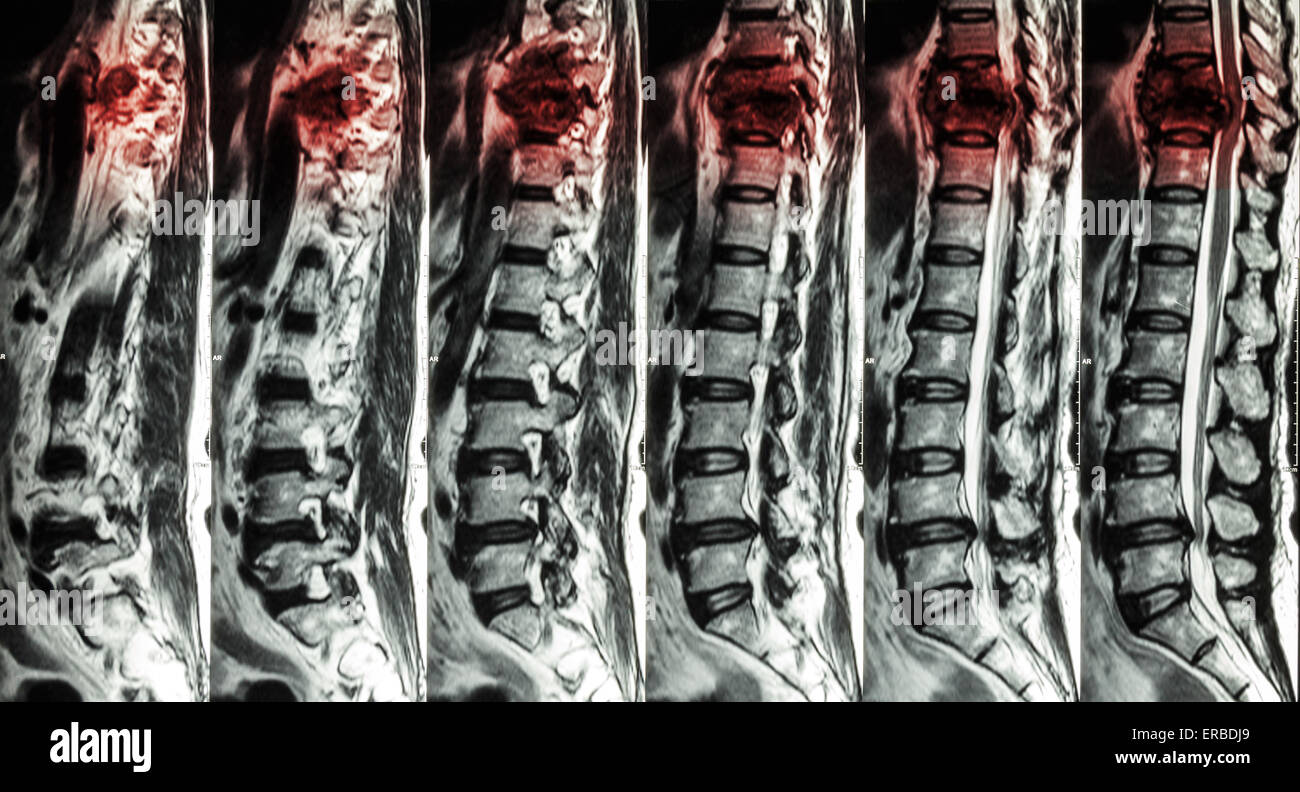 MRI of Lumbar & Thoracic spine : show fracture of thoracic spine and compress spinal cord ( Myelopathy ) Stock Photo