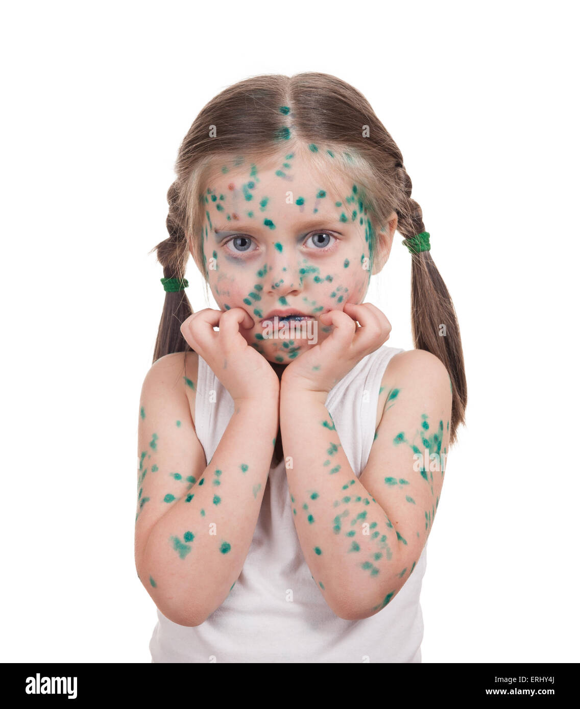 sick child. chickenpox. isolated Stock Photo Alamy