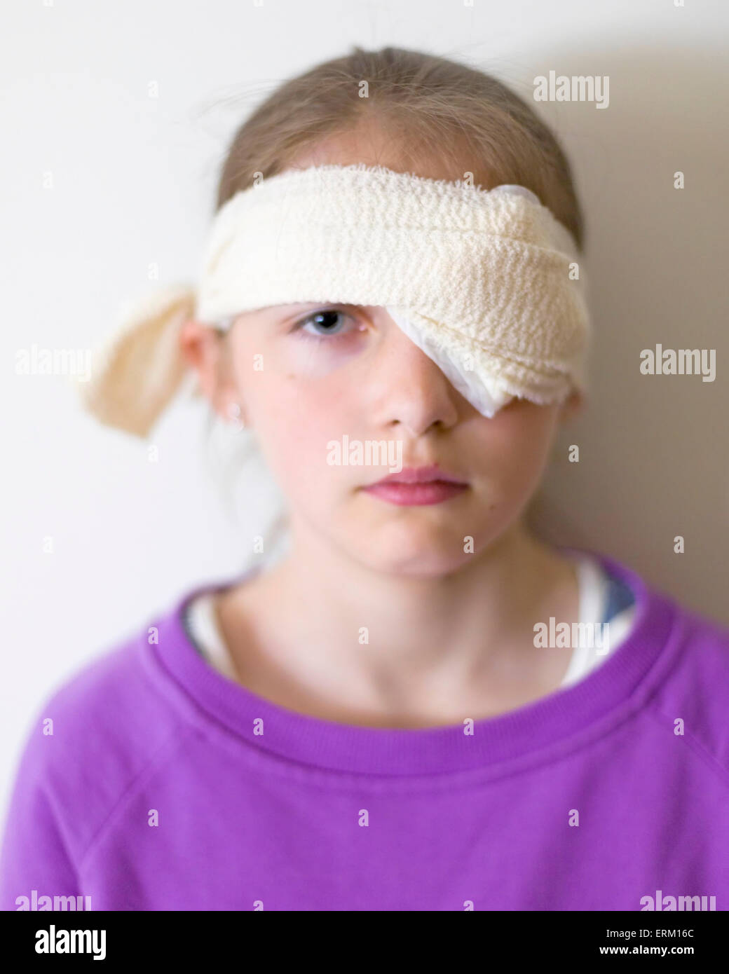 Young girl wearing home made eyepatch or eye pad under bandaging due to corneal abrasion, a scratched cornea. This was made in an effort to relieve some of the symptoms of corneal abrasion such as eye pain, tearing and redness, blurred or loss of vision, but in this case mainly due to sensitivity to light.   Model Release: Yes.  Property Release: No. Stock Photo