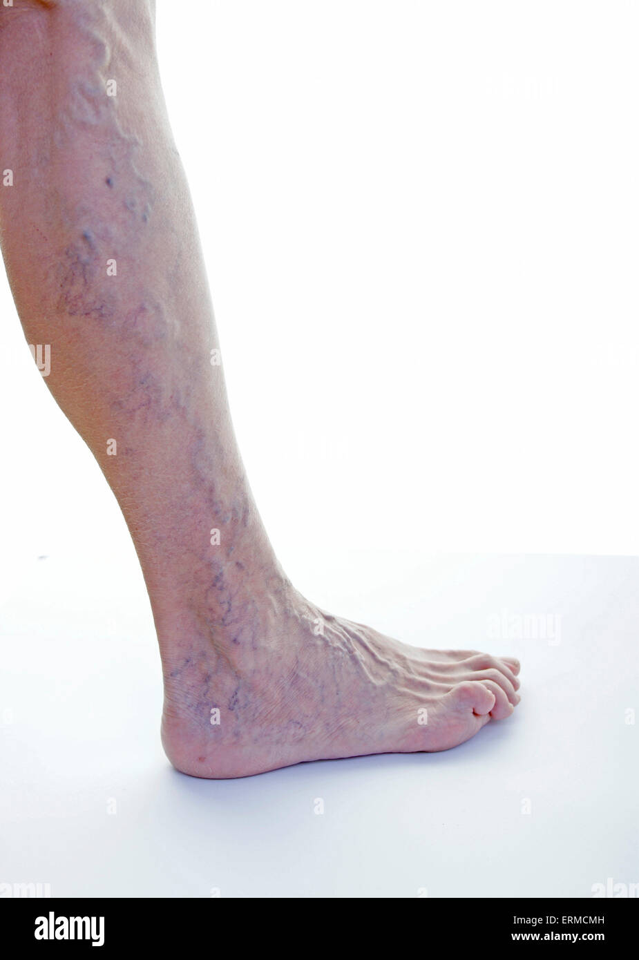 Varicose veins leg (female, age 68 years) / Krampfadern Varizen am Bein (Frau, Alter 68 Jahre) Stock Photo