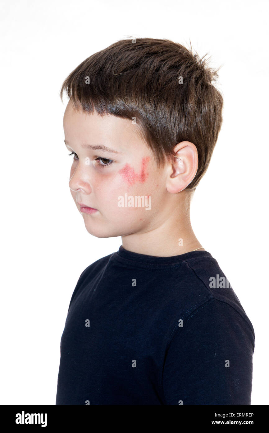 sad boy with a scraped face Stock Photo