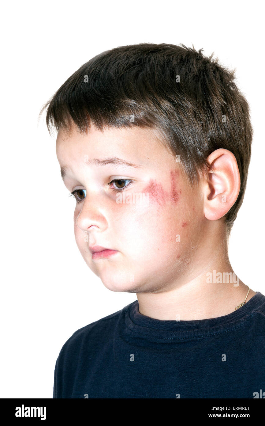 sad boy with a scraped face Stock Photo