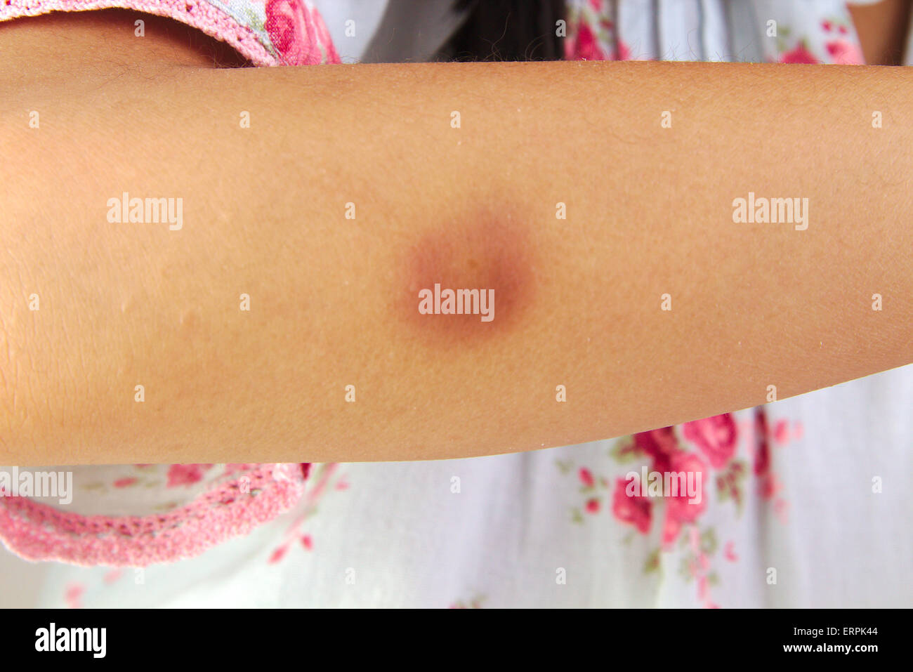 Bruise or hematoma on a wounded girl arm Stock Photo