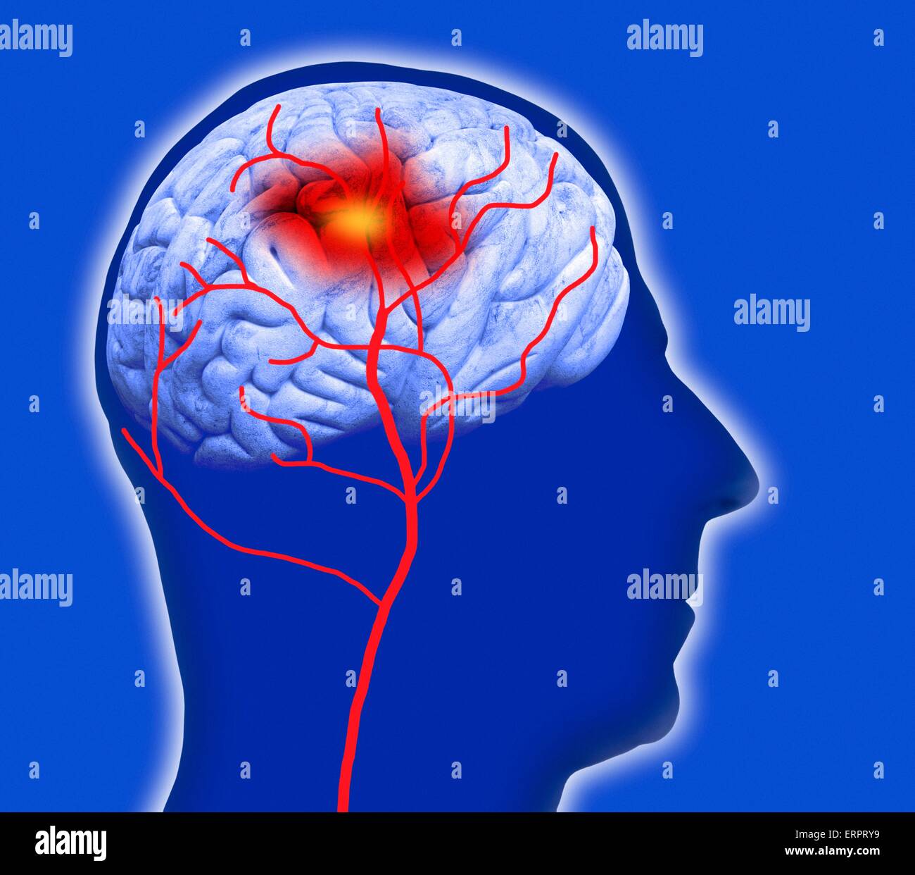 Видео сосудов головного мозга. Мигрень головного мозга. Церебральное кровообращение головного мозга. Мигрень и инсульт.