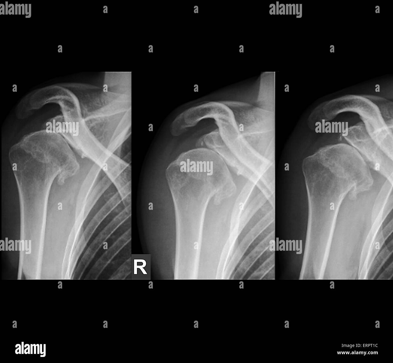 Shoulder x ray Black and White Stock Photos & Images Alamy