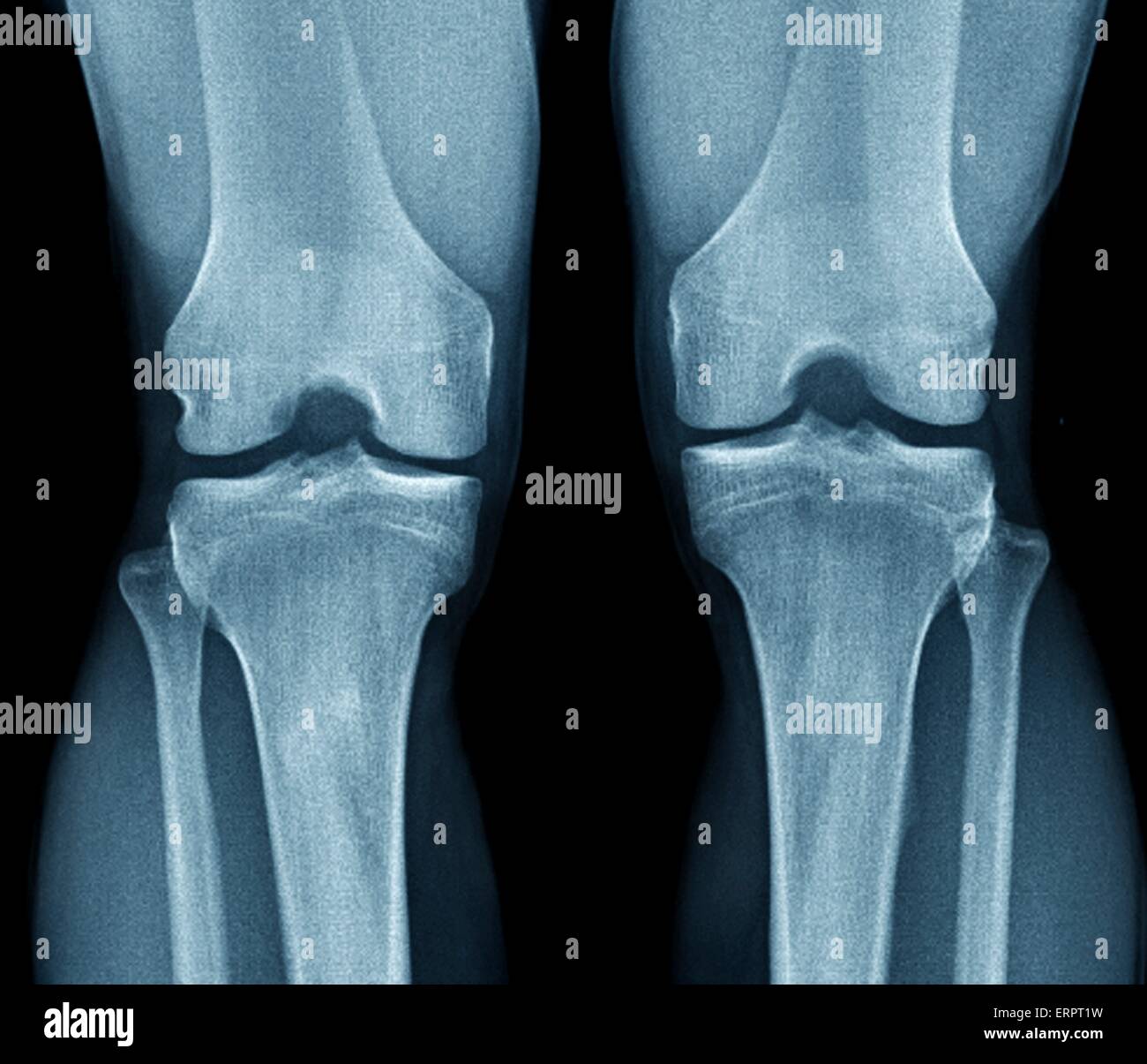Normal knee x ray hires stock photography and images Alamy