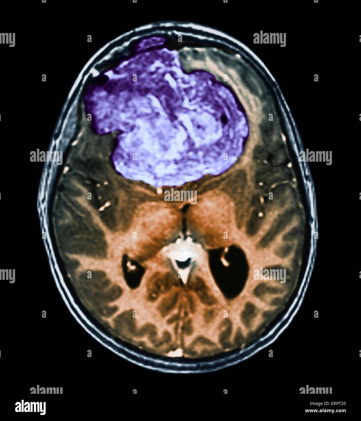 Benign brain tumour. Coloured computed tomography (CT) scan of the brain of a 25 year old patient with a meningioma (purple). This is a benign (non-cancerous) tumour that arises from the meninges, the membranes that surround the brain. It was caused by ra Stock Photo