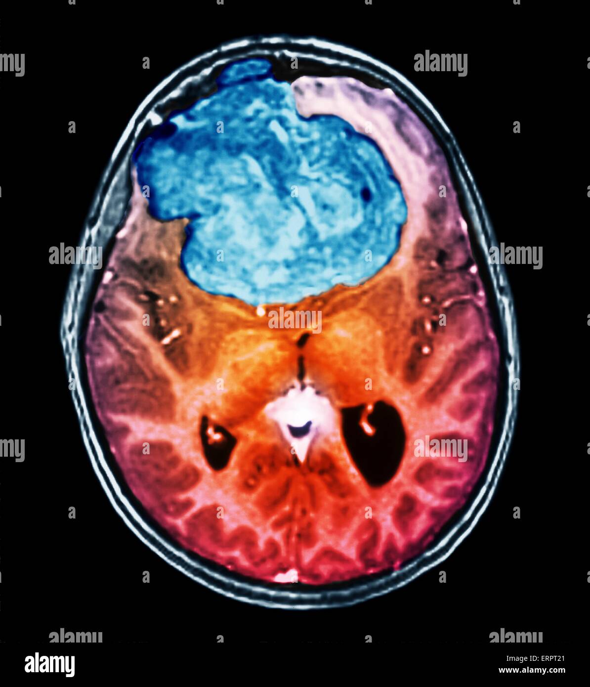 Benign brain tumour. Coloured computed tomography (CT) scan of the brain of a 25 year old patient with a meningioma (blue). This is a benign (non-cancerous) tumour that arises from the meninges, the membranes that surround the brain. It was caused by radi Stock Photo