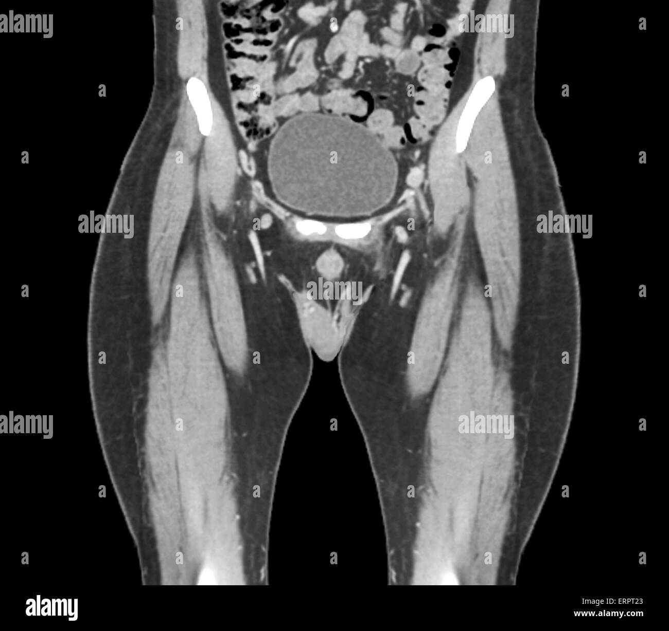 Computed tomography (CT) scan of the healthy full bladder (oval) of a 45 year old patient. Stock Photo