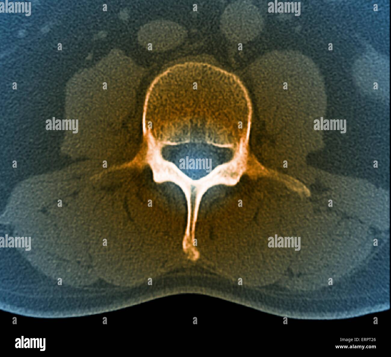 Lumbar vertebra hi-res stock photography and images - Alamy