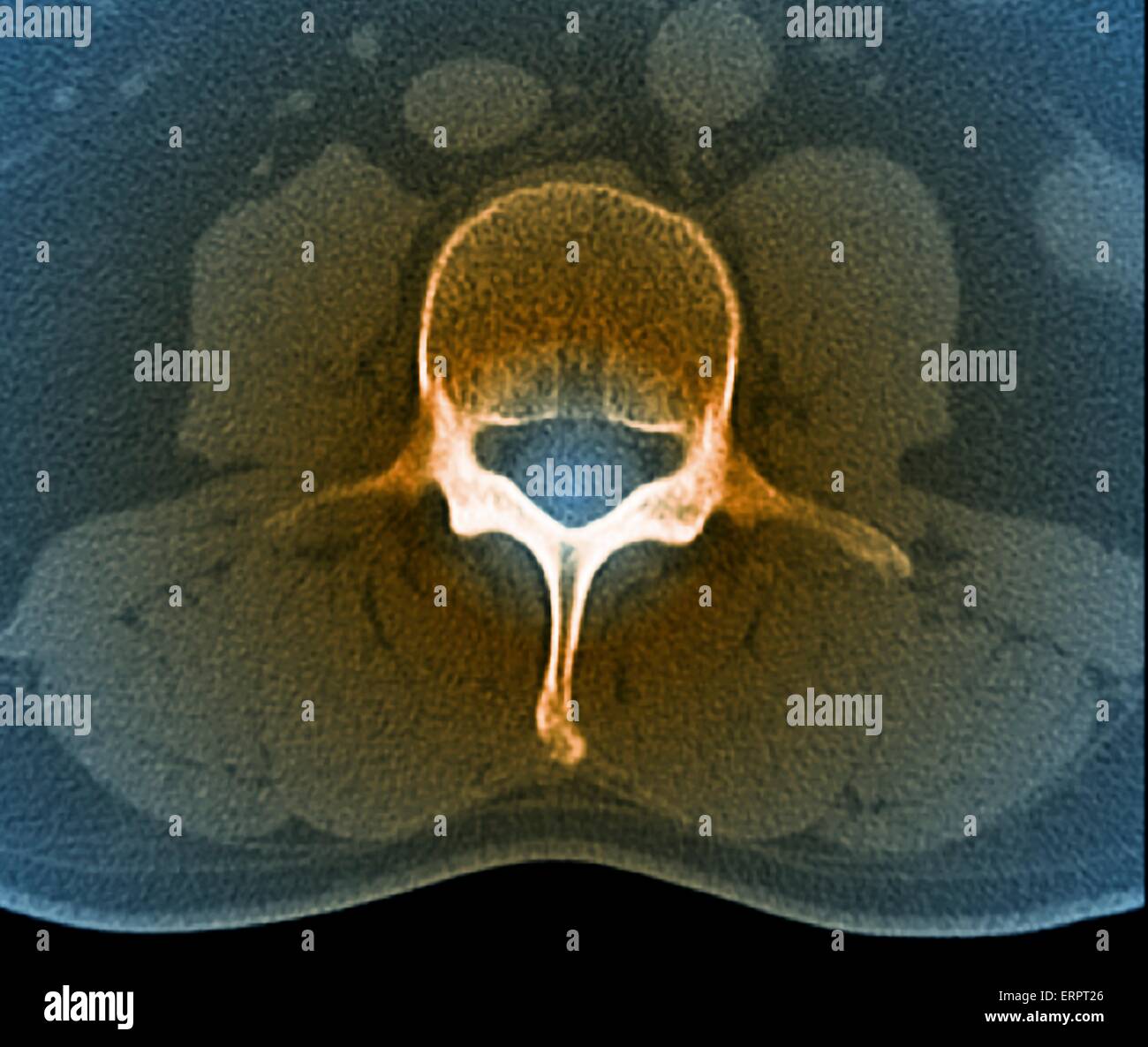 Coloured axial computed tomography (CT) scan of a healthy lumbar vertebra (L3) in a 33 year old patient. The front of the body is at top. Stock Photo