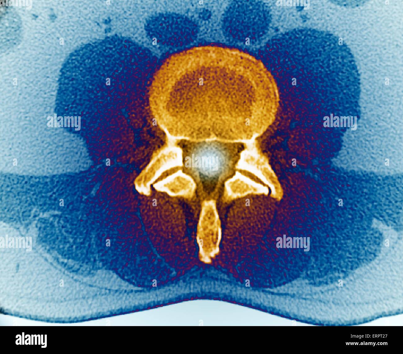 Coloured axial computed tomography (CT) scan of a healthy lumbar vertebra (L3) in a 33 year old patient. The front of the body is at top. Stock Photo