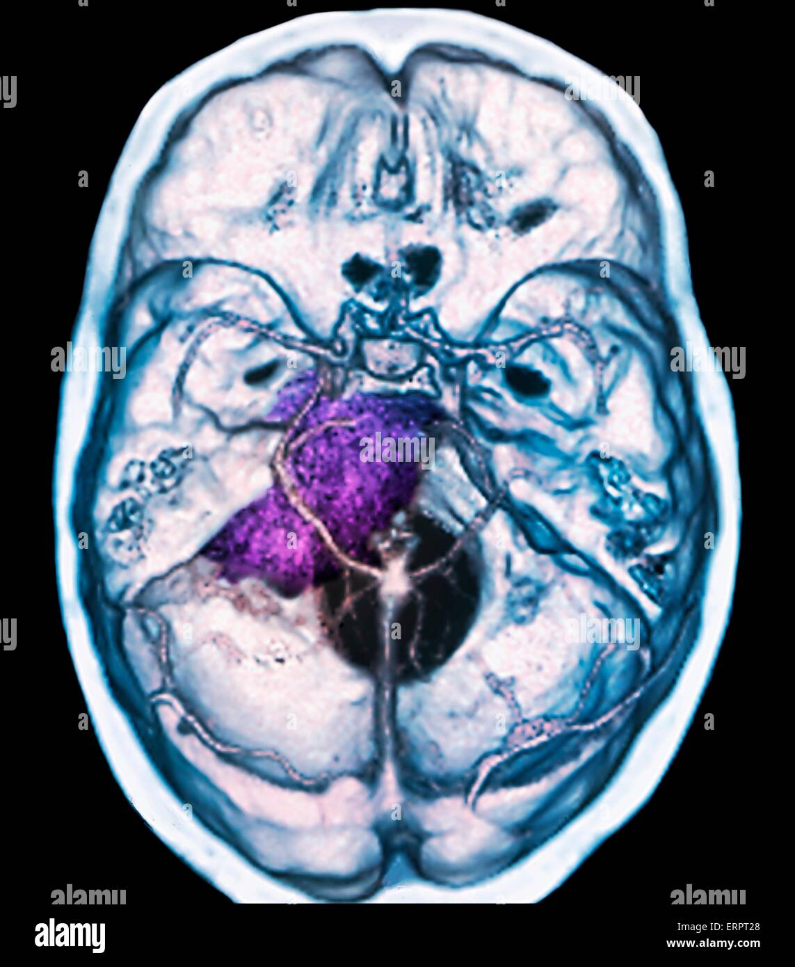 Benign brain tumour. Coloured computed tomography (CT) scan of the brain of a 48 year old patient with a meningioma (purple). This is a benign (non-cancerous) tumour that arises from the meninges, the membranes that surround the brain. Stock Photo