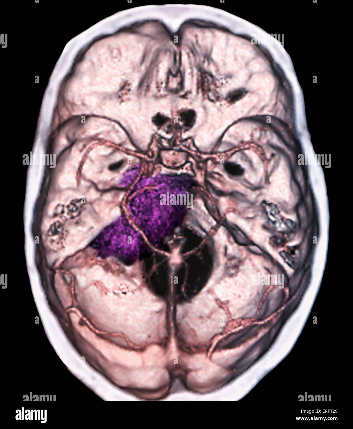 Benign brain tumour. Coloured computed tomography (CT) scan of the brain of a 48 year old patient with a meningioma (purple). This is a benign (non-cancerous) tumour that arises from the meninges, the membranes that surround the brain. Stock Photo