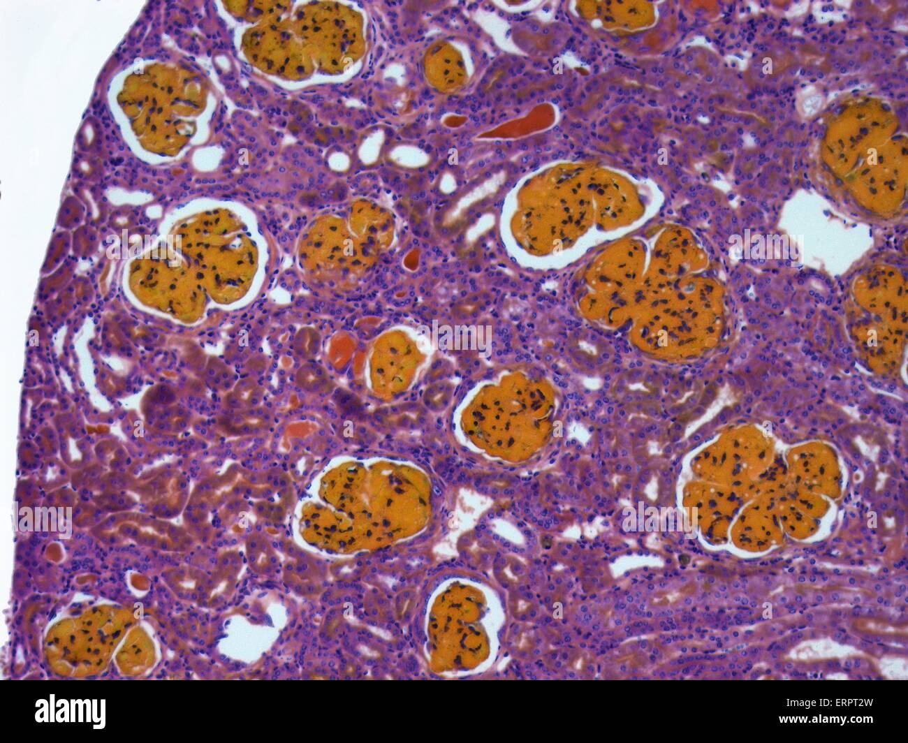 Glomerulonephritis. Light micrograph of tissue from a kidney in a case of glomerulonephritis. This condition refers to inflammation of the glomeruli (yellow structures), the filtering structures of a kidney. In the chronic form, the renal glomeruli and tu Stock Photo