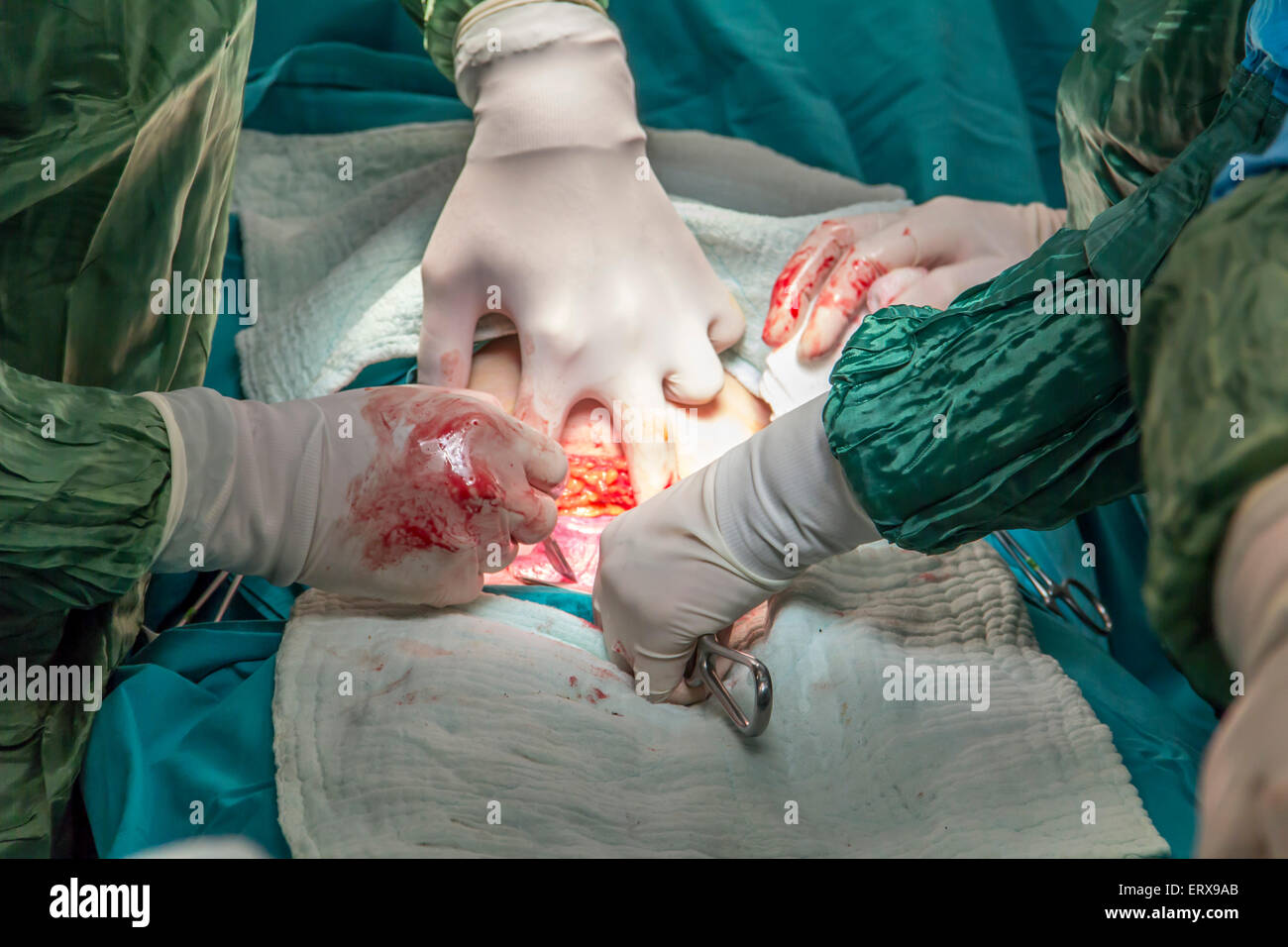 childbirth in operation room c-section surgery Stock Photo
